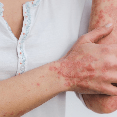 psoriasis et cbd