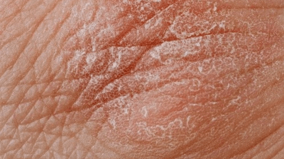 symptomes du psoriasis